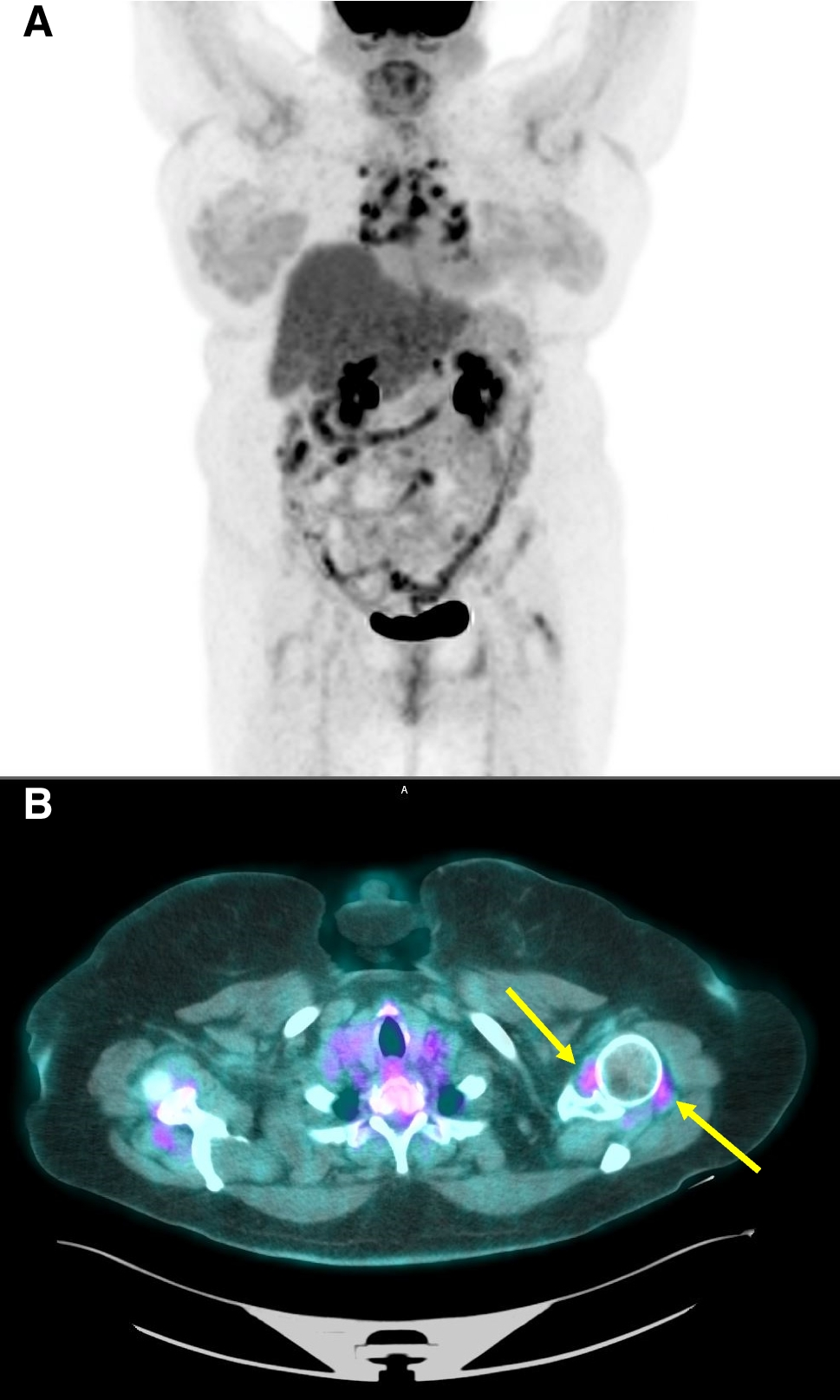 Non-FDG PET/CT imaging of inflammatory arthritis