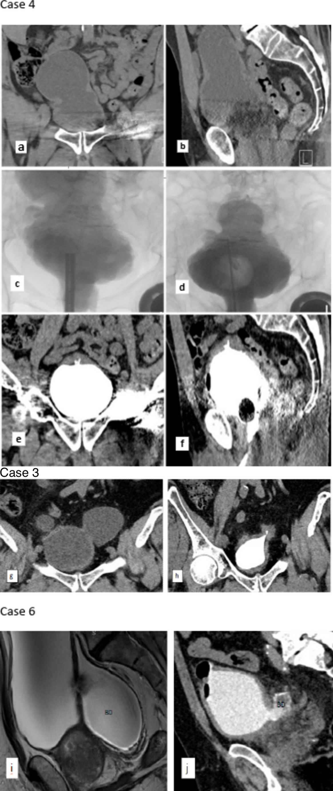Safety and efficacy of concomitant holmium laser enucleation of the prostate with transurethral endoscopic management of symptomatic large bladder diverticulum: revisiting a historical technique in the modern era with literature review