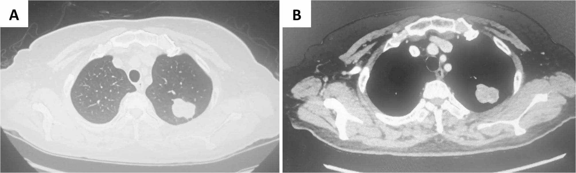 Clinical management and long-term outcomes in pulmonary inflammatory myofibroblastic tumor: a 12-Year experience with 14 surgically treated adult patients at a single center