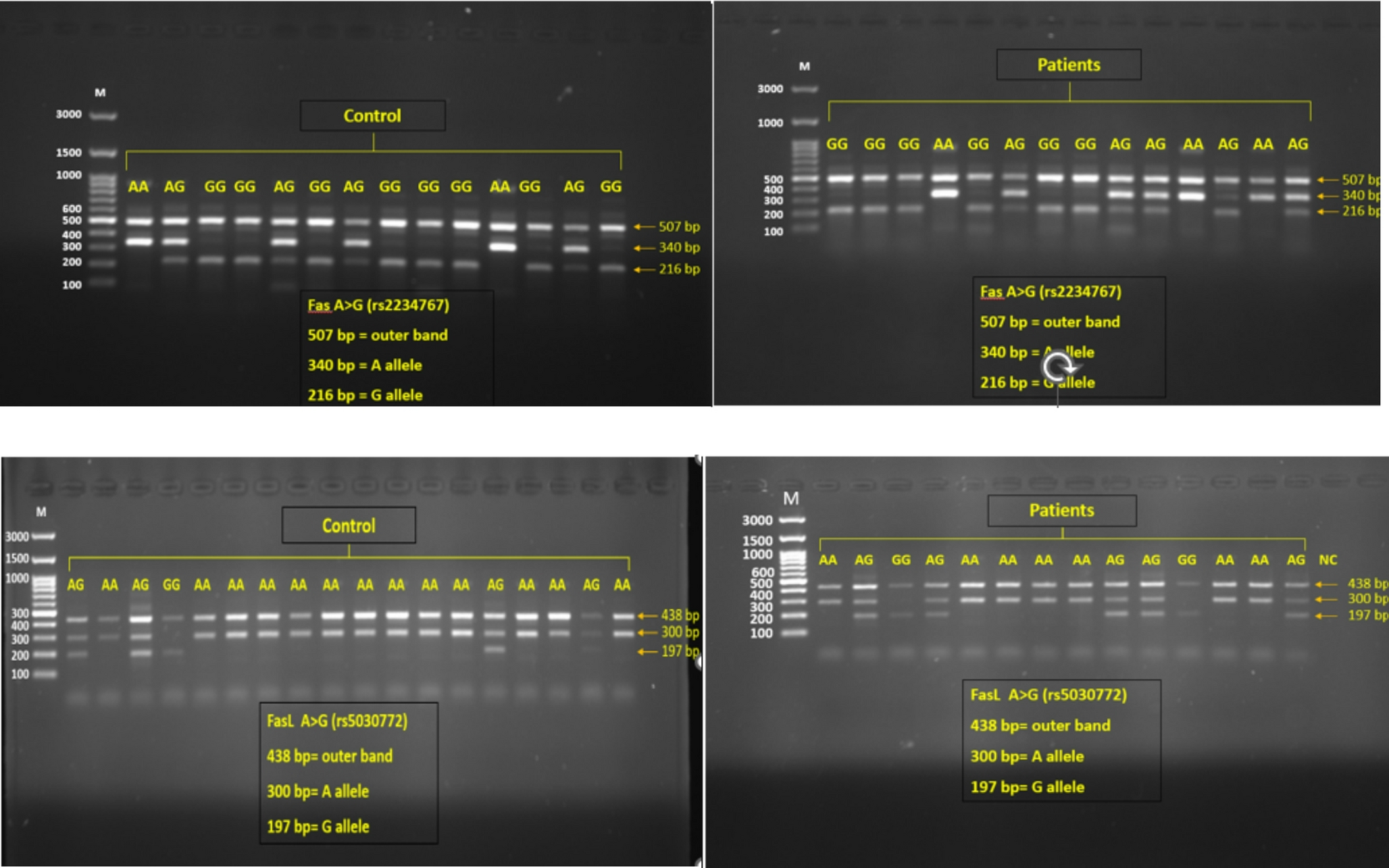 Genetic Polymorphisms in FAS/FASL Apoptotic Pathway Genes Modulate Beta-Thalassemia Susceptibility and Oxidative Stress Response: A Case–Control Study