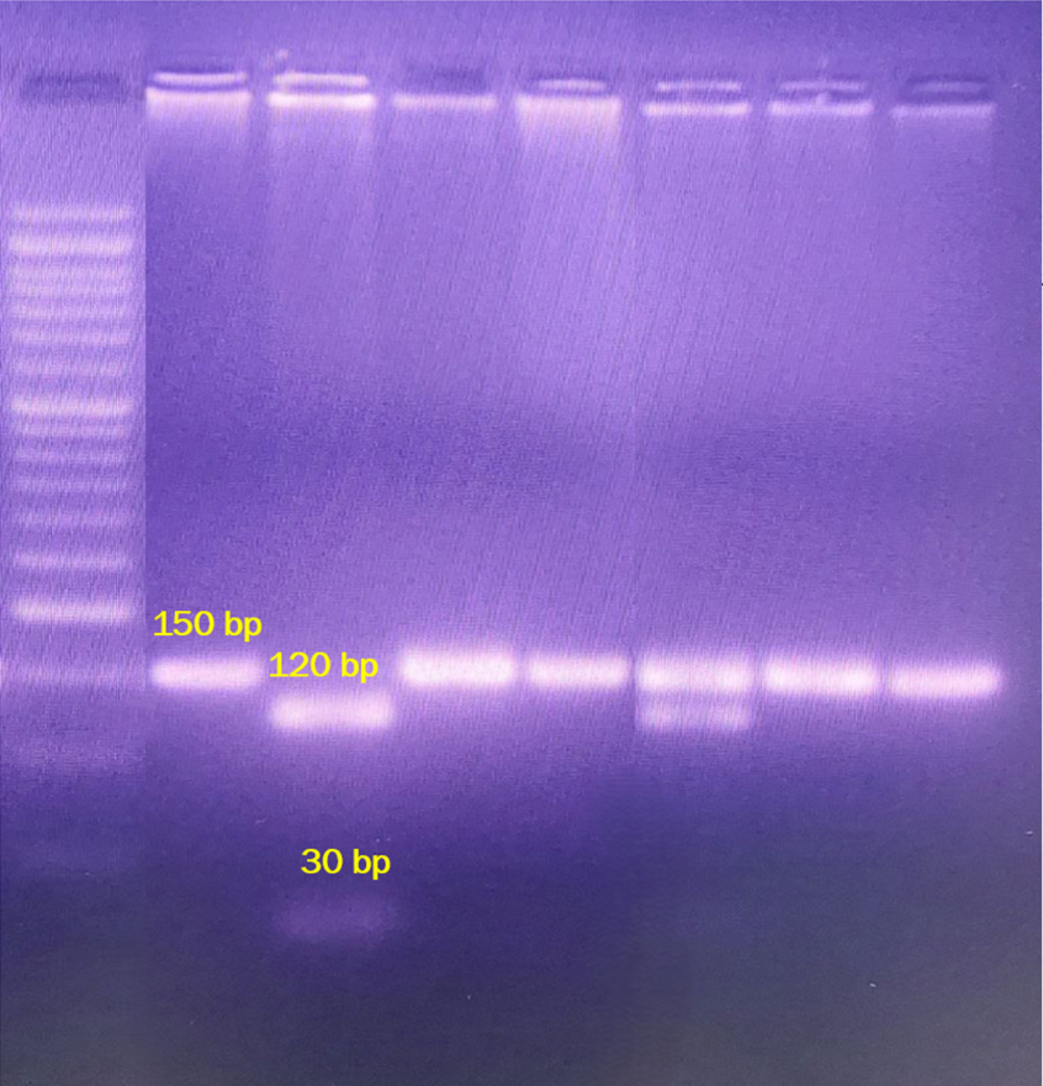 Exploring the Association of MMP-7 Promoter Site Single Nucleotide Polymorphism with Risk of Diabetic Nephropathy