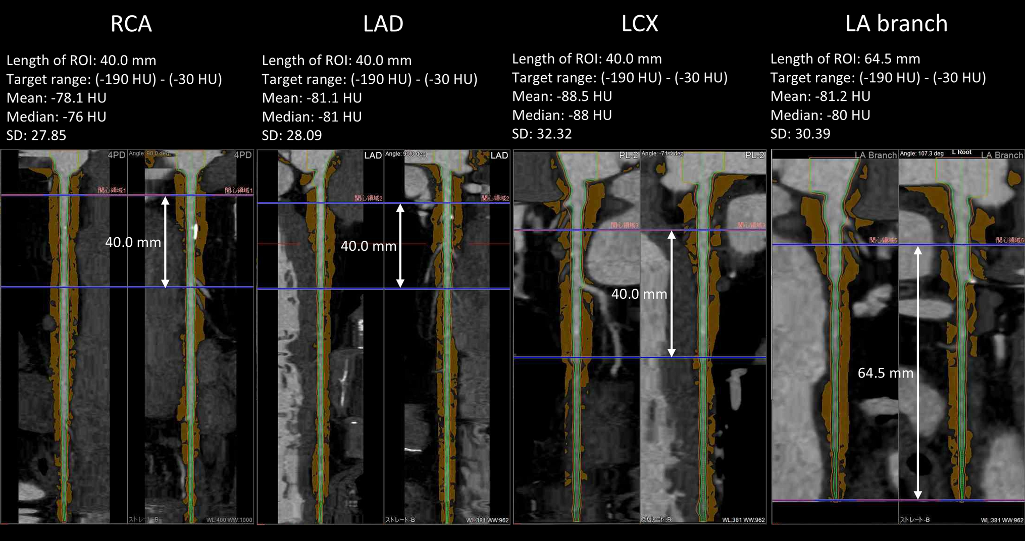 Impact of pericoronary adipose tissue attenuation and coronary microvascular dysfunction on cardiac remodeling and dysfunction