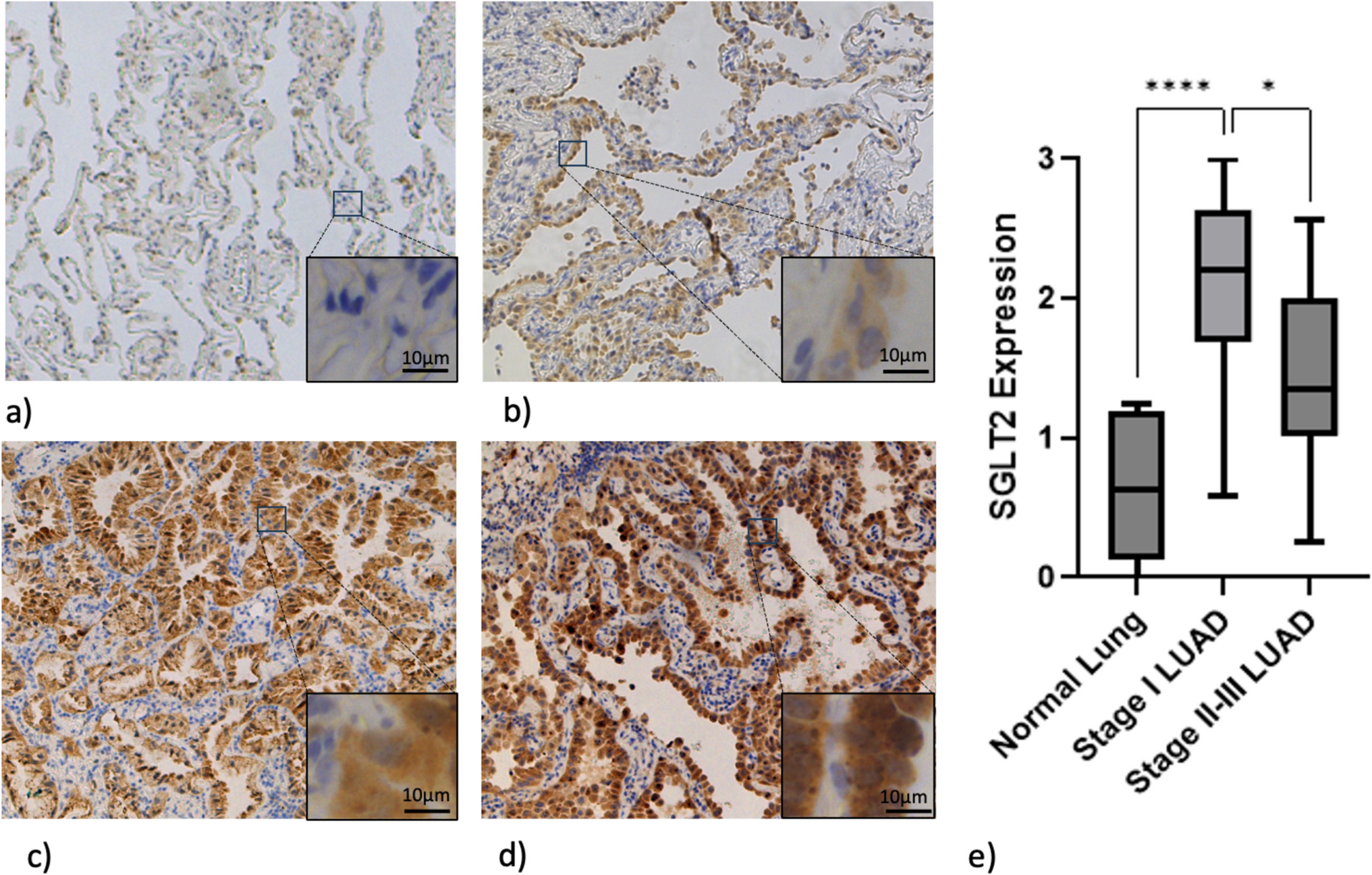 Preclinical Evaluation of Novel SGLT2-Targeted Near-Infrared Optical Imaging Agent for Early-Stage Pulmonary Adenocarcinoma