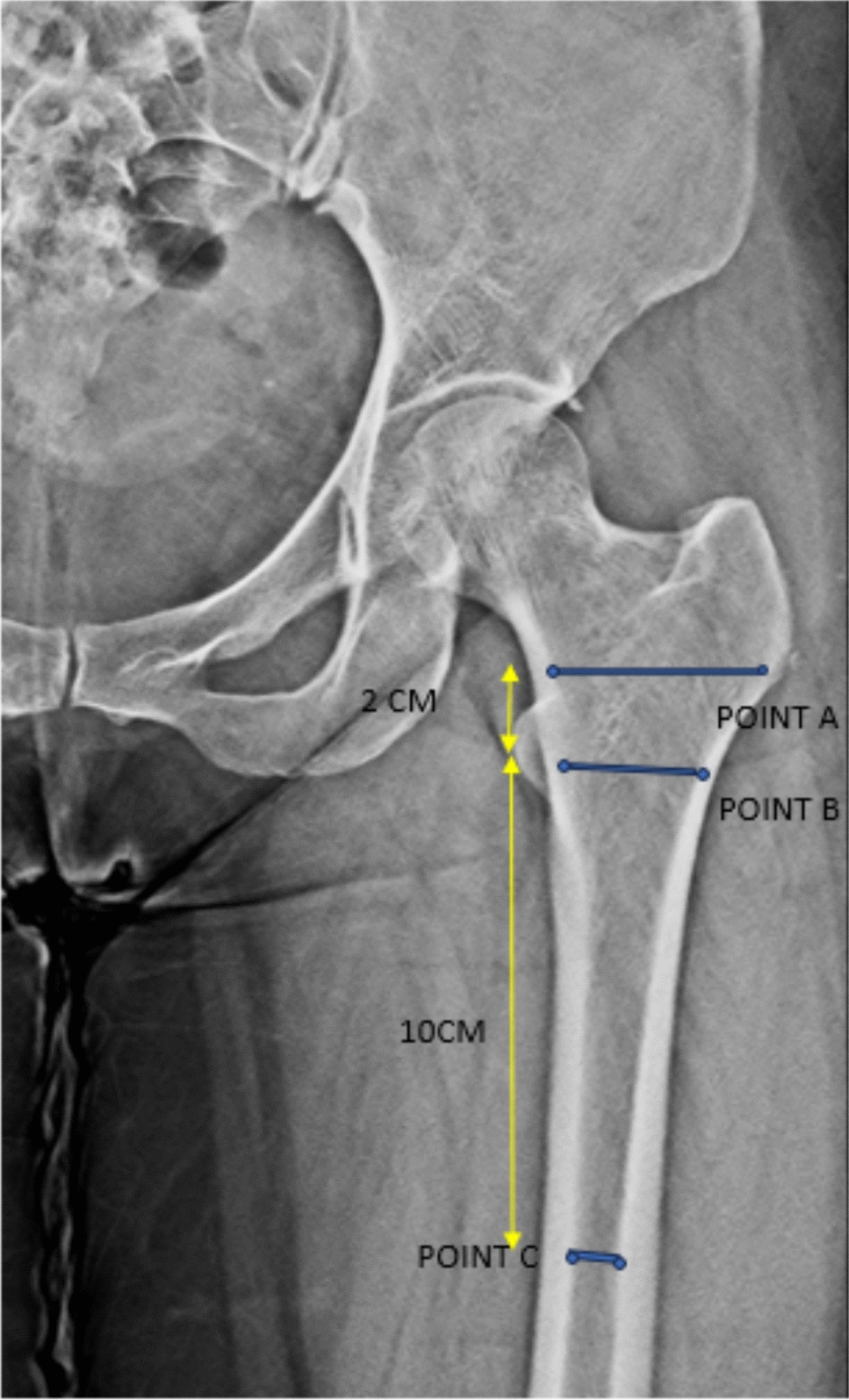 Correlation of Subsidence with Proximal Femoral Anatomy in Hydroxyapatite-Coated vs Non-hydroxyapatite-coated Collarless Femoral Stems: Radiological Results at a Mean Follow-Up of 4.5 Years