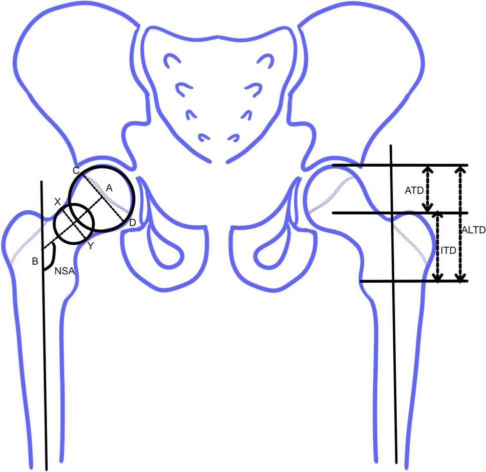 Safety of Conventional Interlocking Nails in Stabilizing Adolescent Femoral Shaft Fractures: A 14-Year Analysis