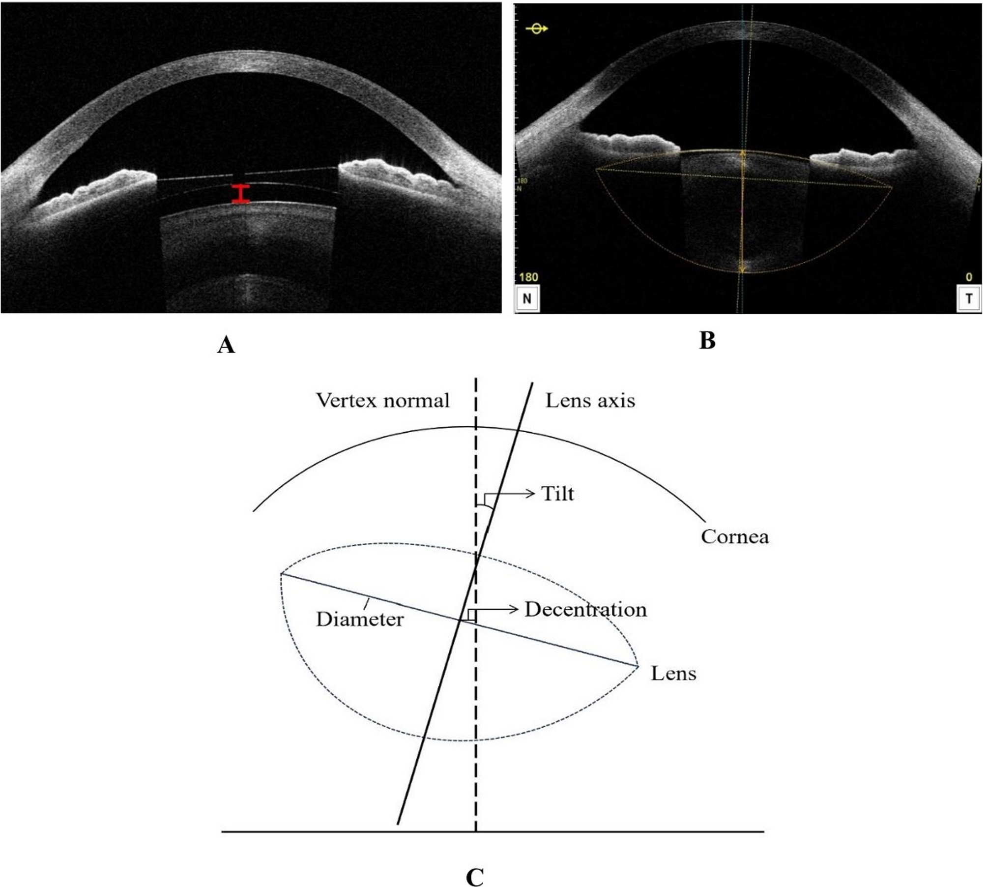 Effects of crystalline lens characteristics on vault after implantable collamer lens implantation