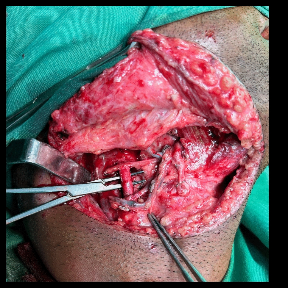 End to Side Microvascular Anastomosis in External Carotid Artery in Vessel Depleted Neck: A Case Series