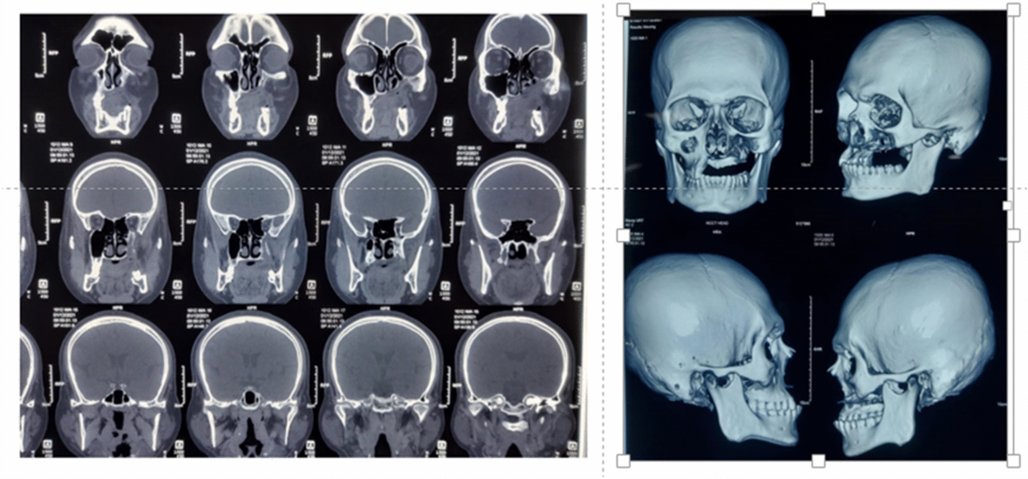 Rehabilitation of Post-COVID Mucormycosis Patients with Zygomatic Implants: Case Series and Clinical Perspectives