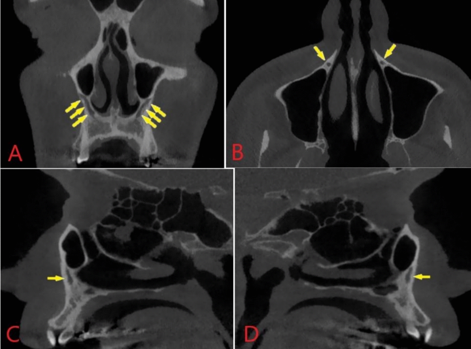 Investigating the Canalis Sinuosus and Its Accessory Canals: A Study Using Cone-Beam Computed Tomography (CBCT)
