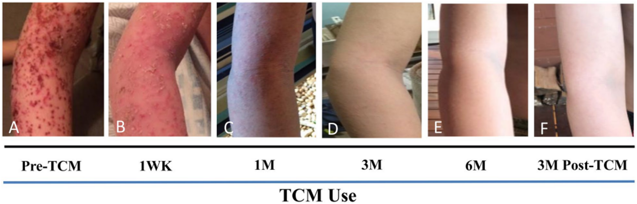 Traditional Chinese Medicine for Pediatric Allergic Diseases