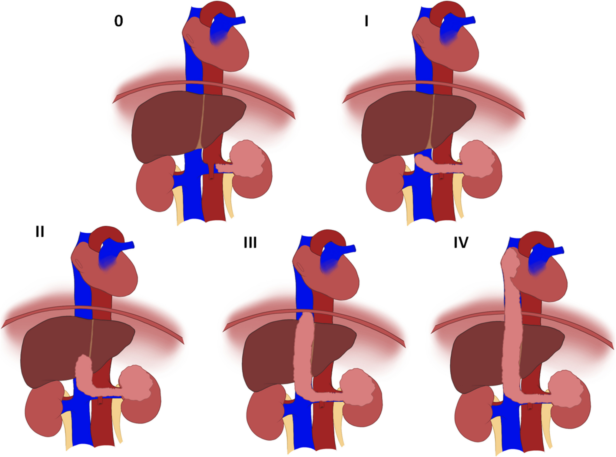 Reviewing the Current State of Renal Cell Carcinoma with a Tumor Thrombus: Epidemiology, Pathophysiology, Metastasis, and Systemic Therapy