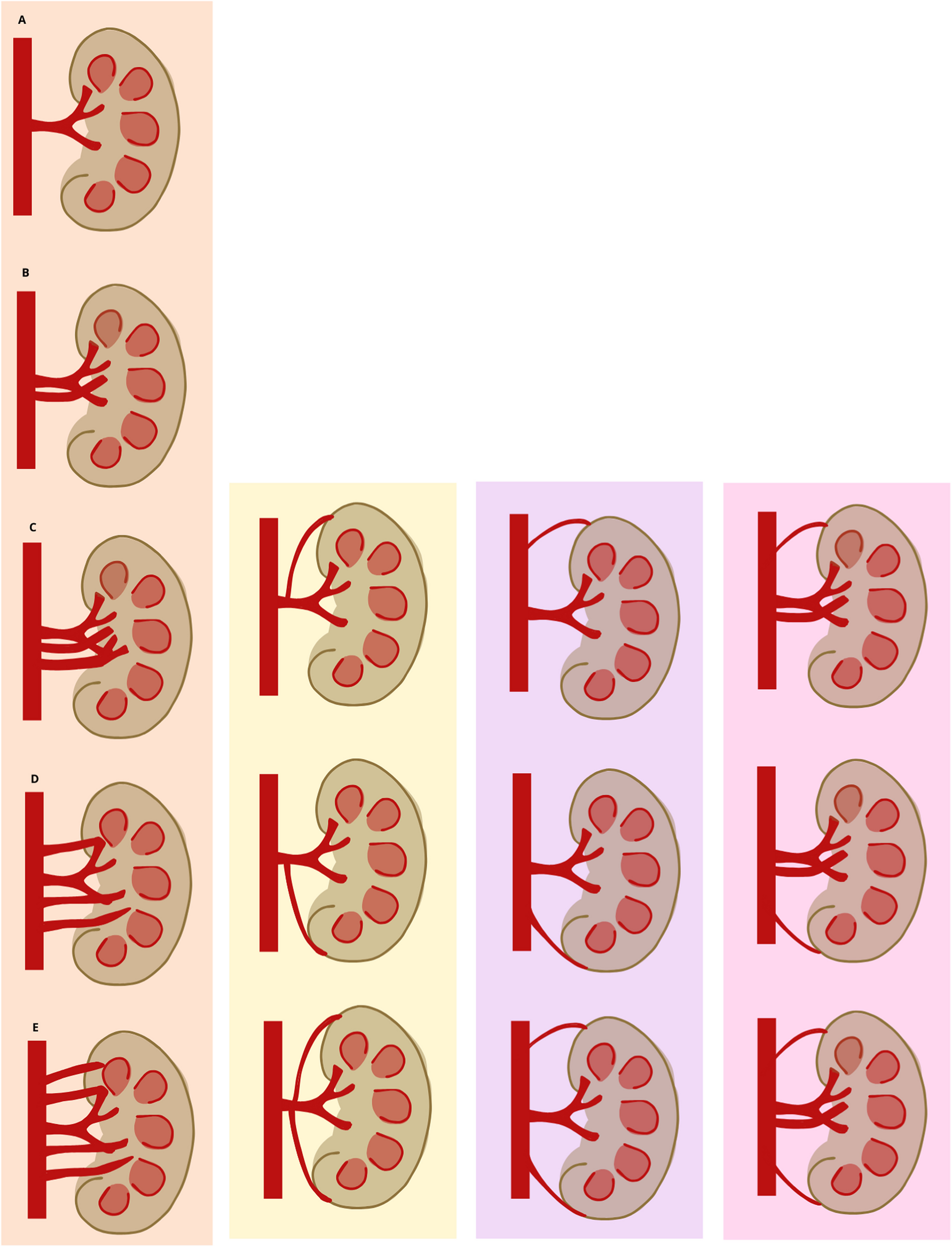 Vascular and Anatomical Challenges in Renal Transplant Surgery; What a Urologist Needs to know