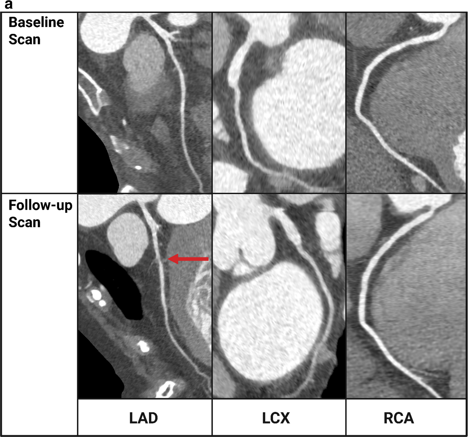 Serial Coronary CTA for Monitoring Response to Lipid-Lowering Therapy: A Narrative Review