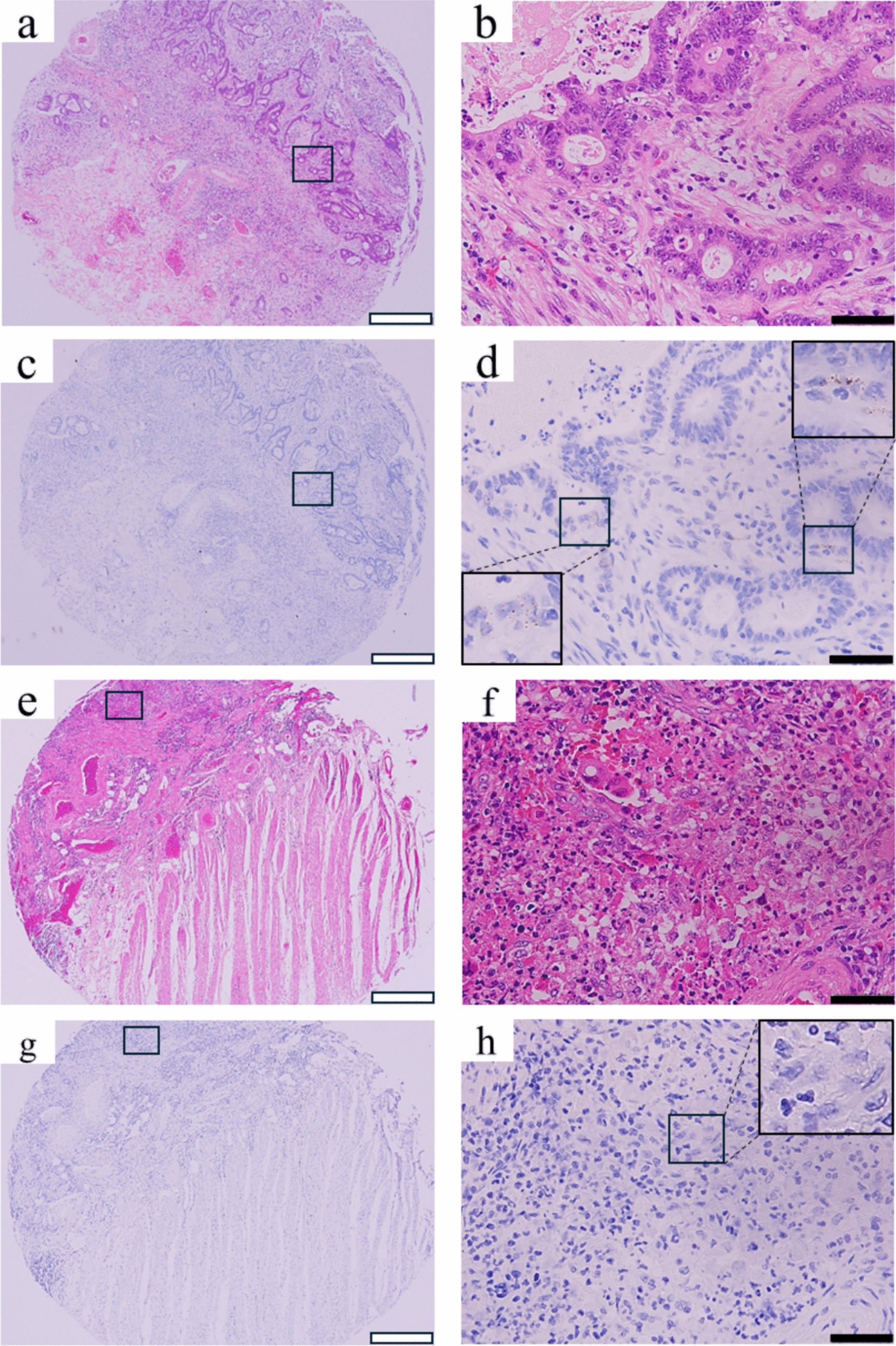 High  Expression Shapes an Immunosuppressive Tumor Microenvironment and Predicts Poor Prognosis in Colorectal Carcinoma