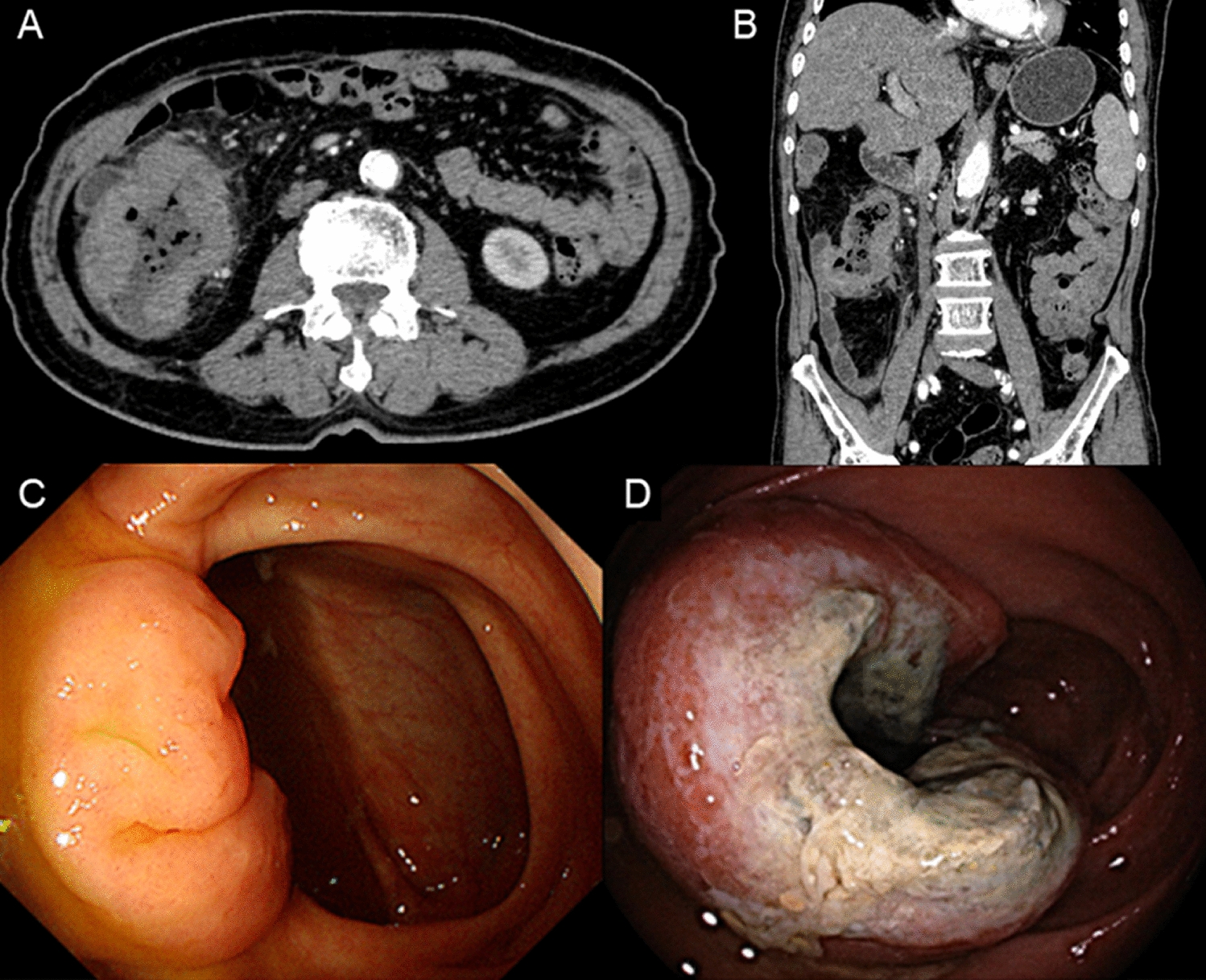 Rapid Onset of Cecal Ulcer After a Negative Colonoscopy: Primary Diffuse Large B-Cell Lymphoma of the Cecum