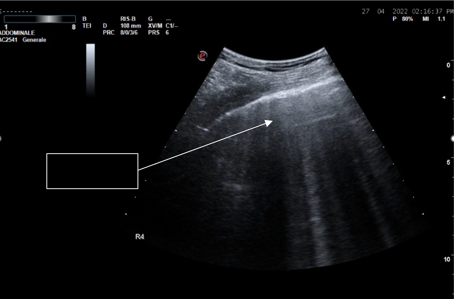 Lung ultrasound in cardiac rehabilitation: expert consensus on protocols, clinical use, and integration into patient management from the working group on cardiac rehabilitation and cardiovascular prevention of the Italian society of cardiology