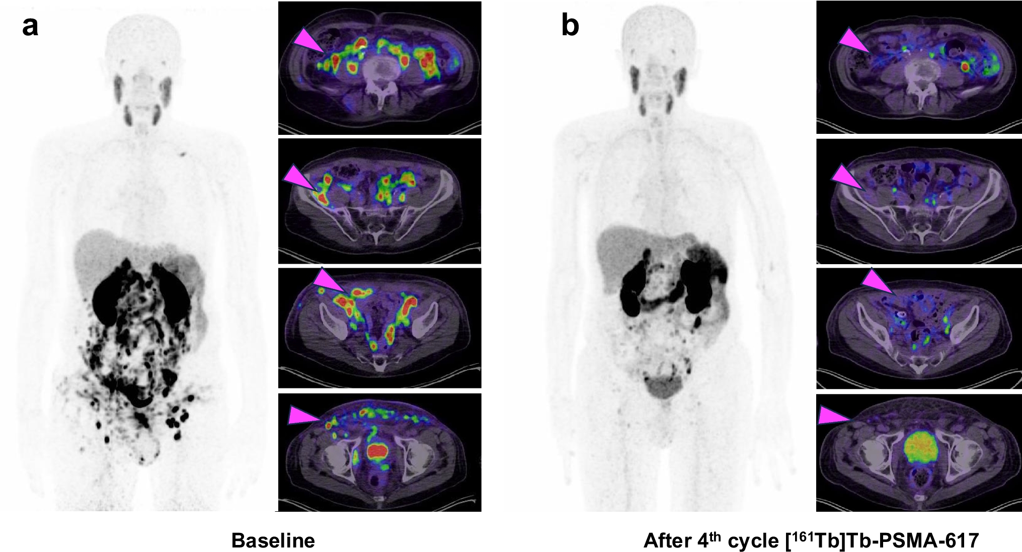 Auger Emitting [Tb]Tb-PSMA-617 Radioligand Therapy in mCRPC with Peritoneal Carcinomatosis