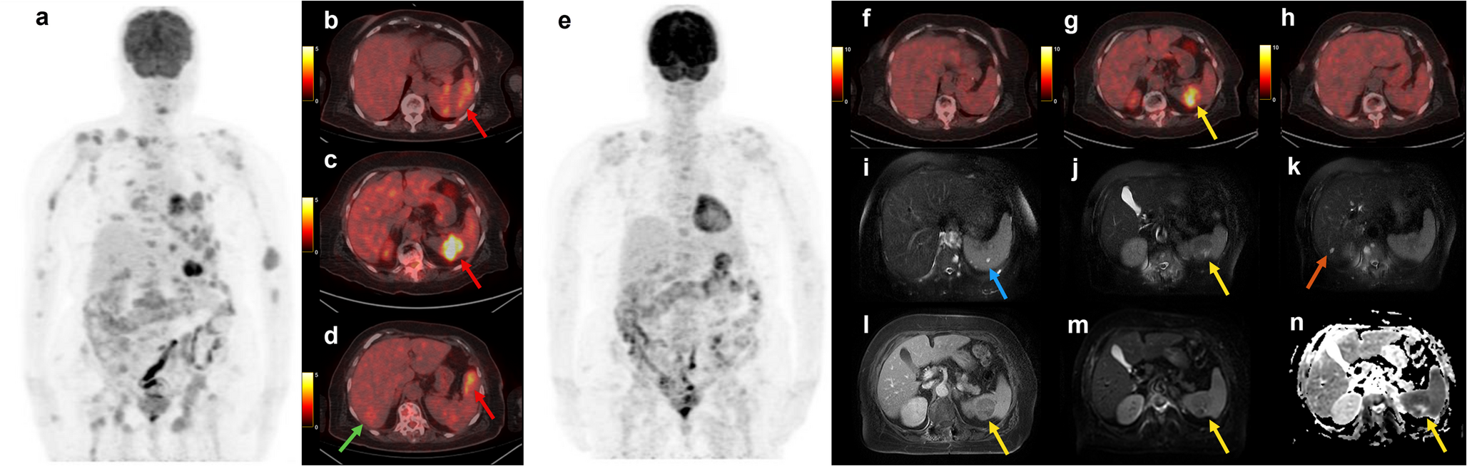 Rare Nodular Hepatosplenic Involvement in Multiple Myeloma: FDG PET/CT and MRI Correlation with Treatment Response