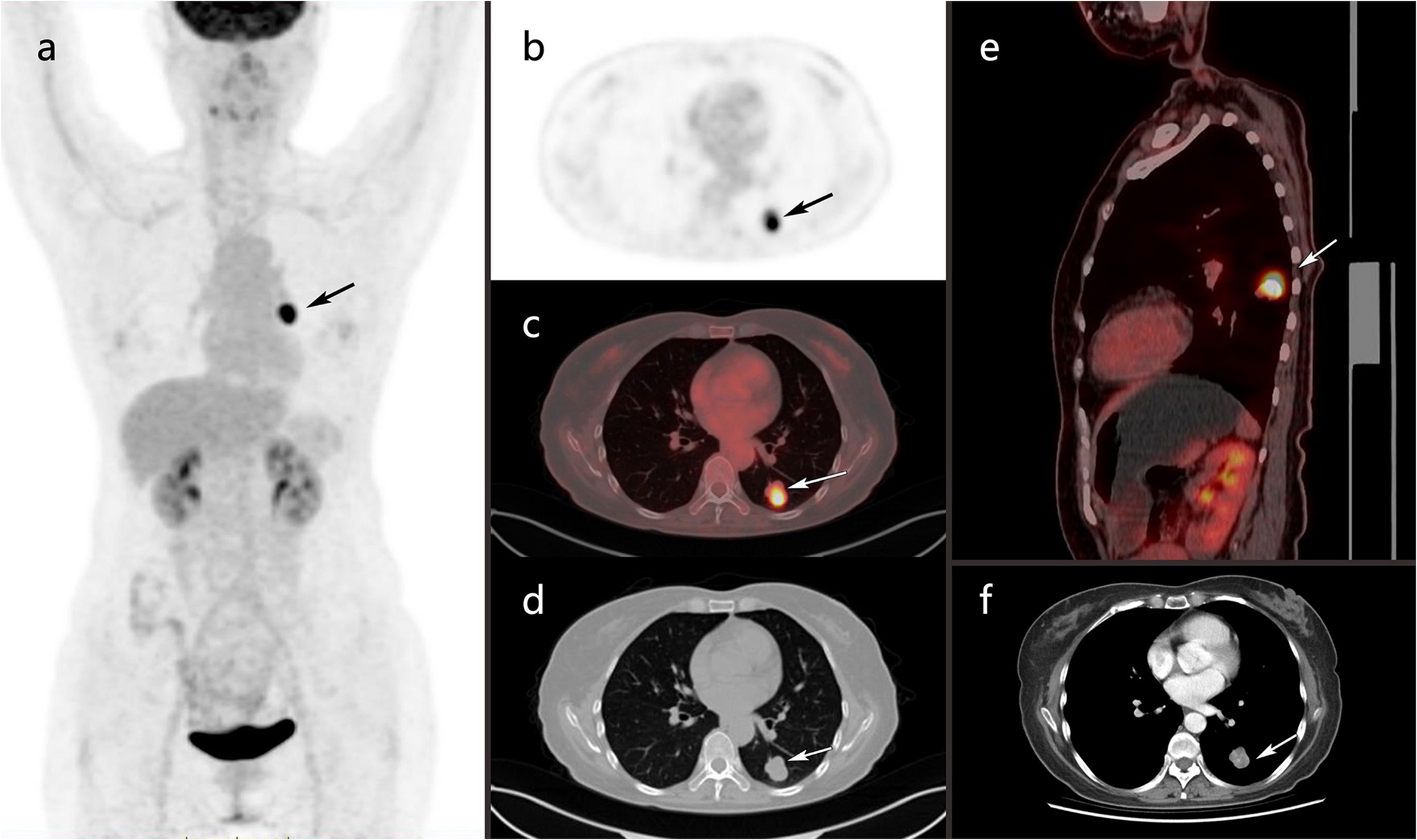 Sporadic MPNST in the Lung Parenchyma: An Early-Stage Case Highlighting F-18-FDG PET/CT Features