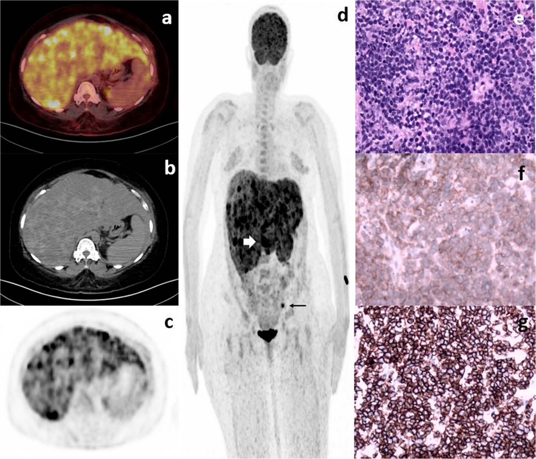 Diffuse Large B-Cell Lymphoma Confined to the Liver: Diagnostic Role of FDG PET/CT in an Unusual Presentation