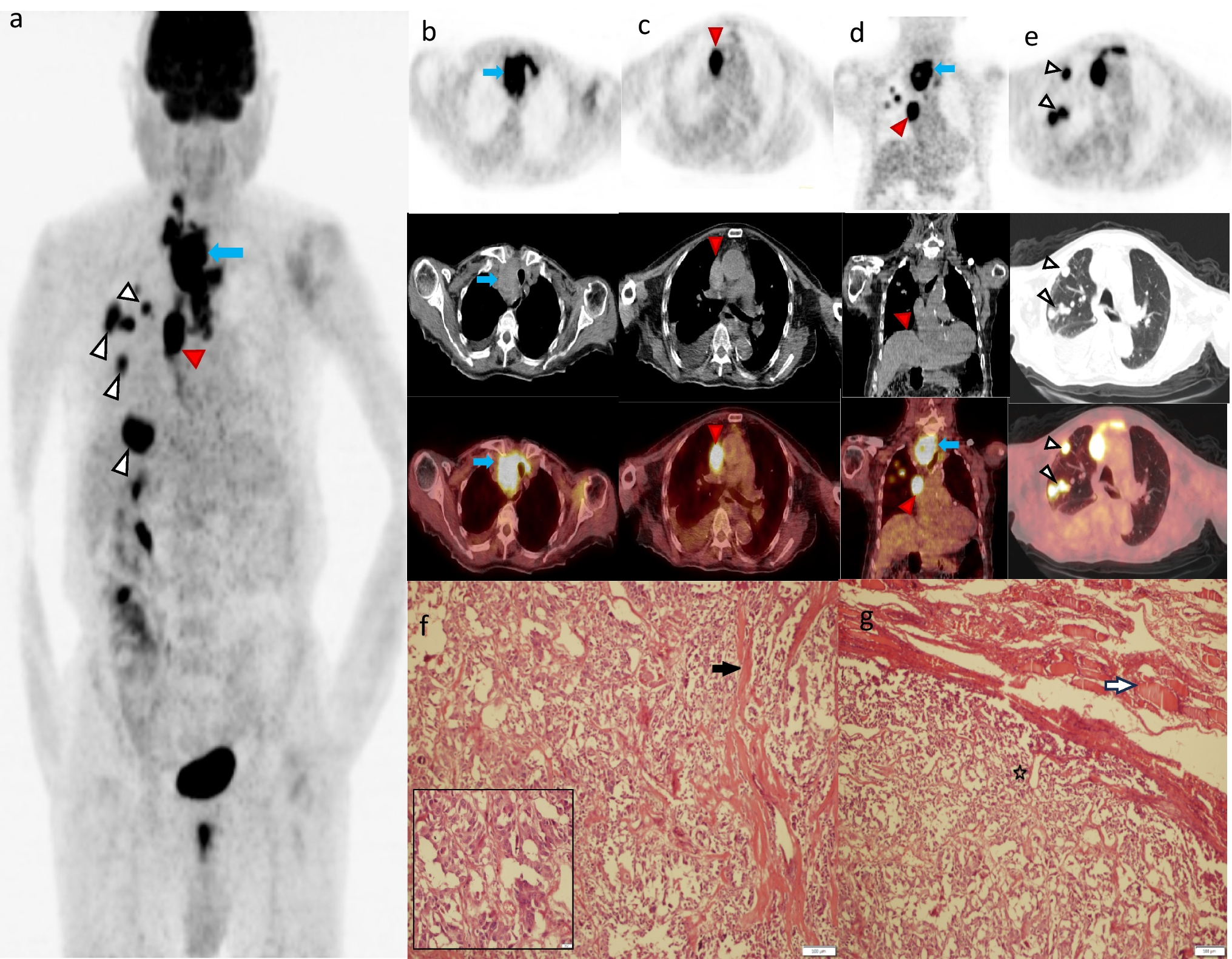 Superior Vena Cava Syndrome in Medullary Thyroid Carcinoma Detected with F-FDG PET/CT; an Extremely Rare Complication