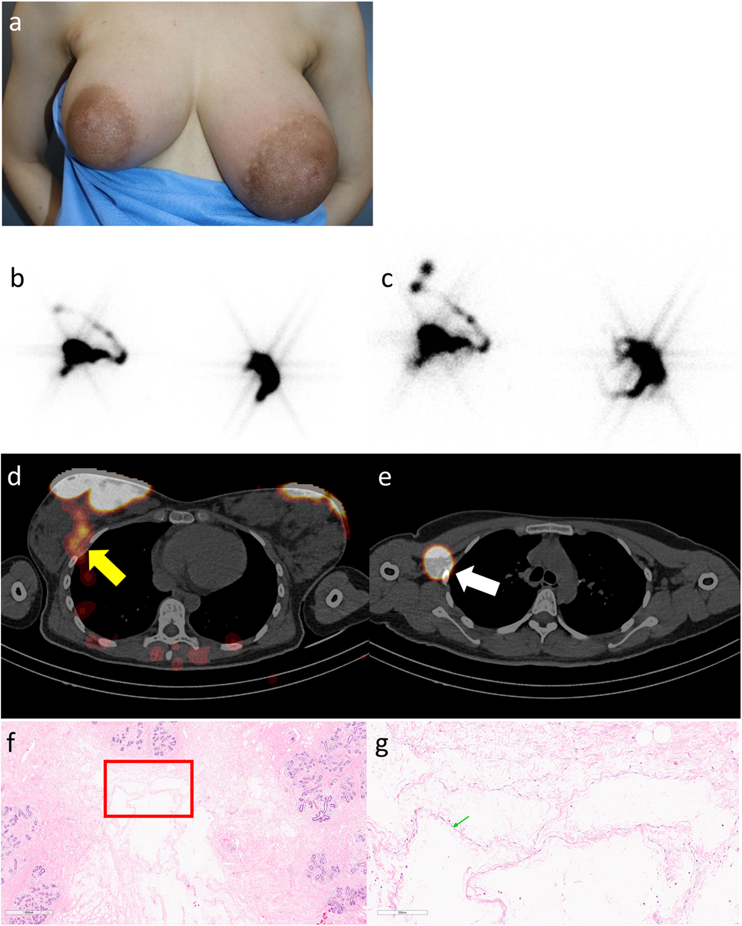 COVID-19 Vaccination Induced Gigantomastia and Breast Lymphedema Visualized on Breast Lymphoscintigraphy and Single-Photon Emission Computed Tomography/Computed Tomography
