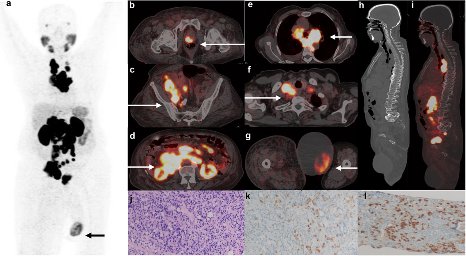 A Case of Adenocarcinoma Prostate with Focal Neuroendocrine Differentiation Showing Unusual Pattern of Metastatic Involvement on Ga-PSMA 11 PET/CT
