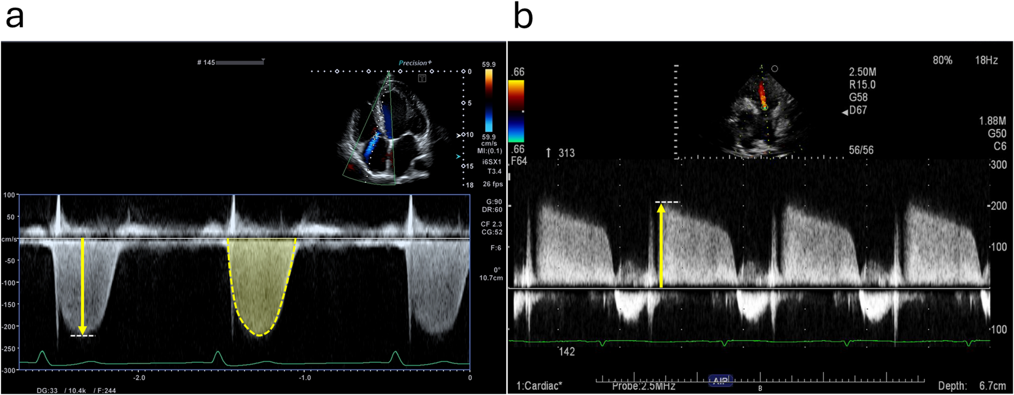Echocardiographic Estimation of right ventricular stroke work index based on pulmonary regurgitant velocity in heart failure with reduced ejection fraction