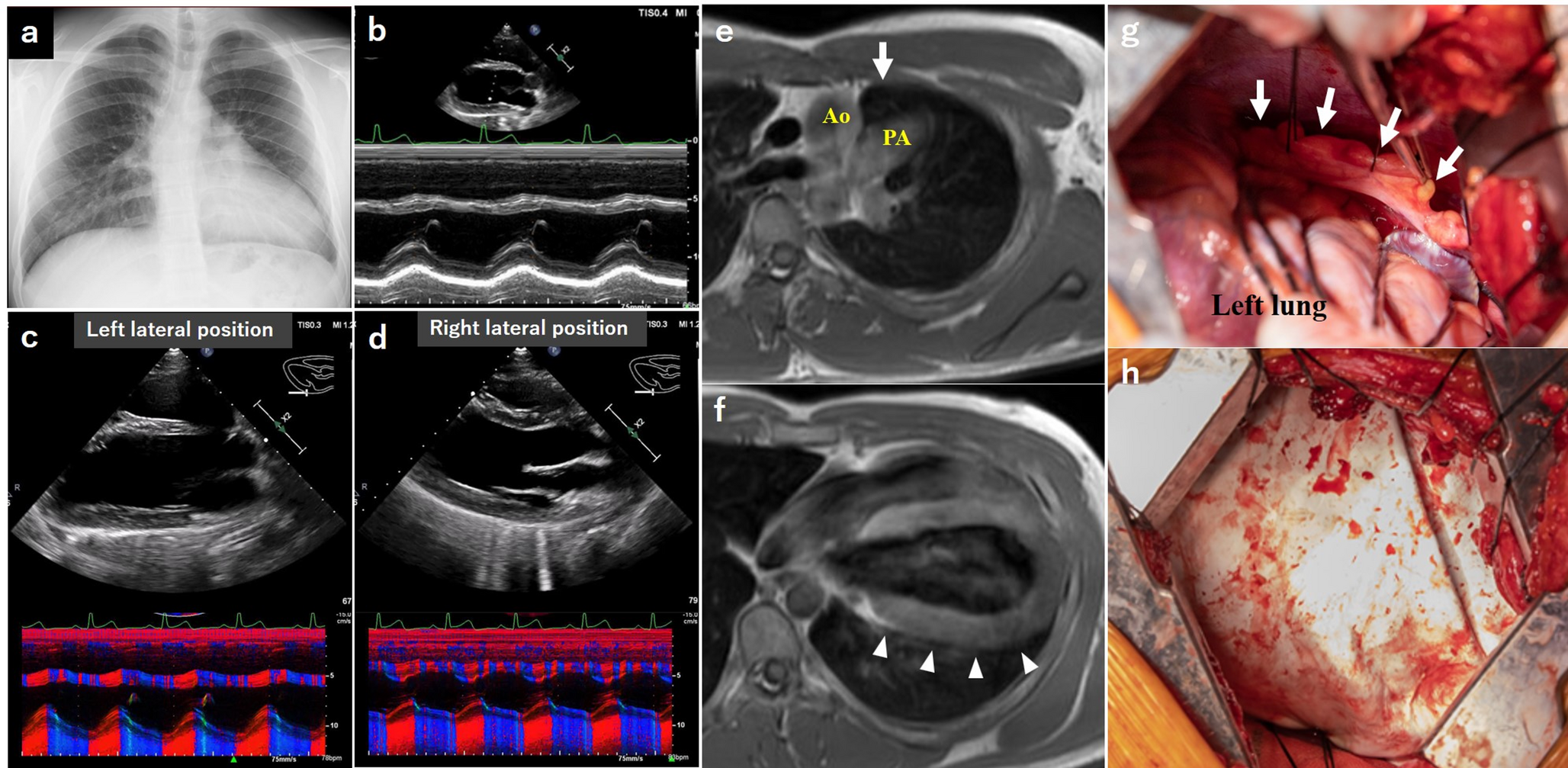 Effective surgical option for congenital complete left-sided pericardial defect