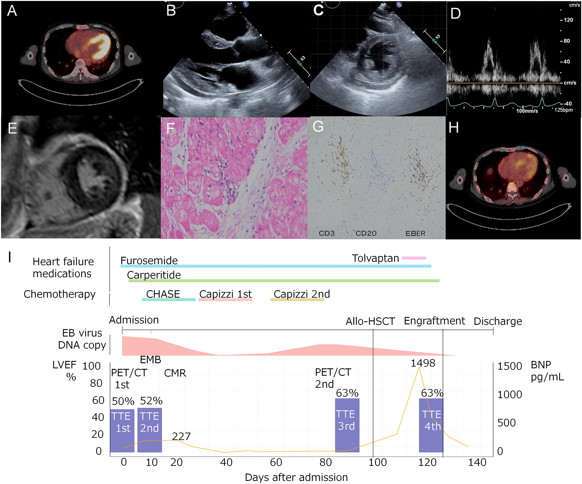 Myocarditis in chronic active Epstein-Barr virus infection: multi-modality assessment