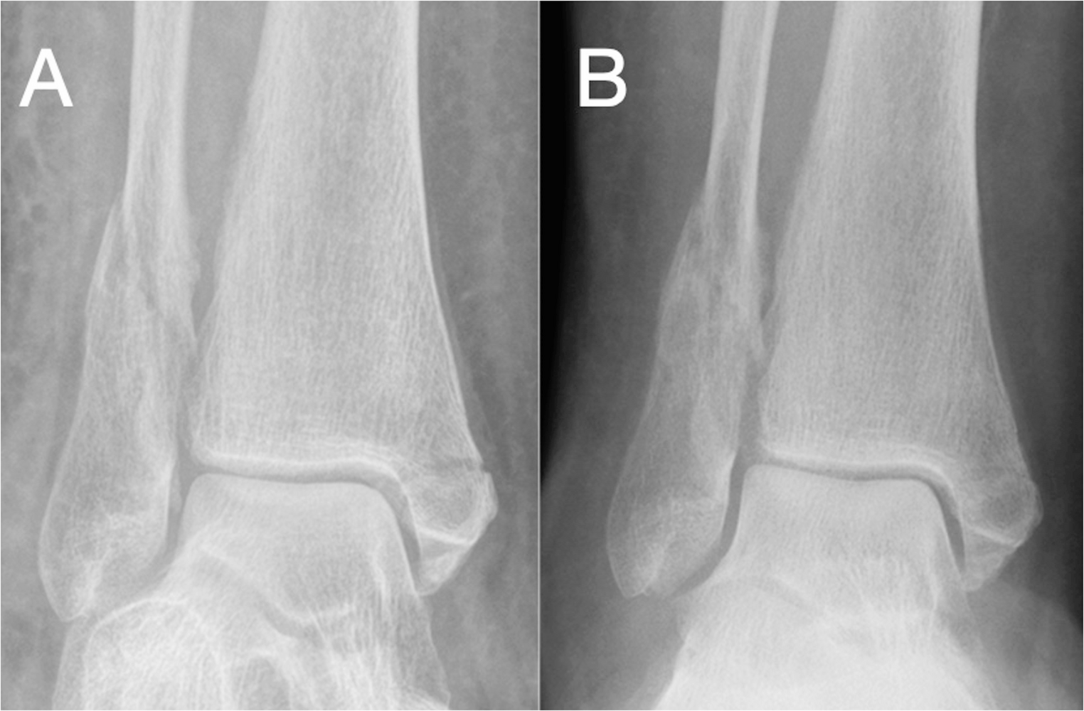 Management of Geriatric Ankle Fractures