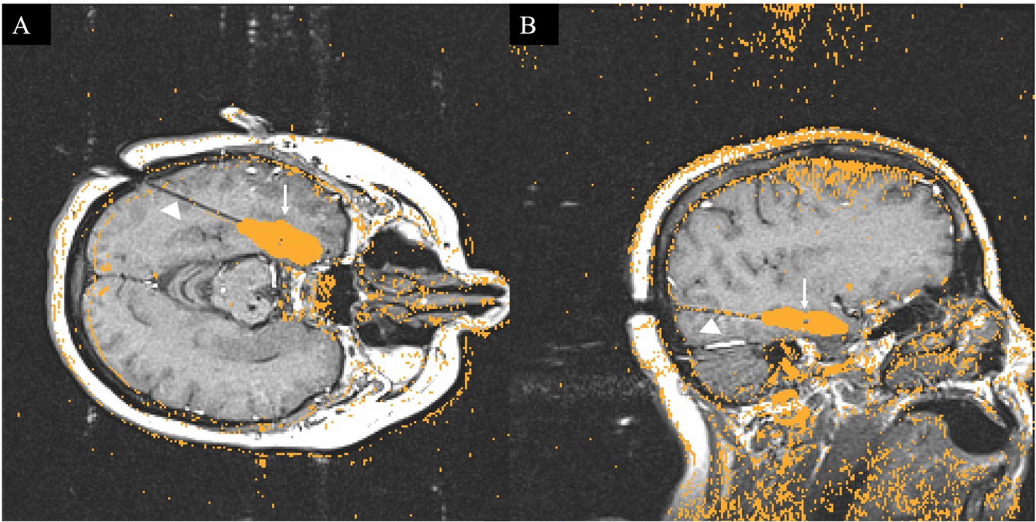 Laser Interstitial Thermal Therapy for Epilepsy