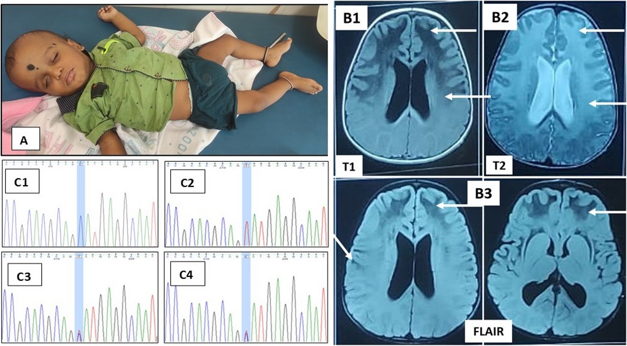 Alexander Disease Due to a Homozygous  Variant