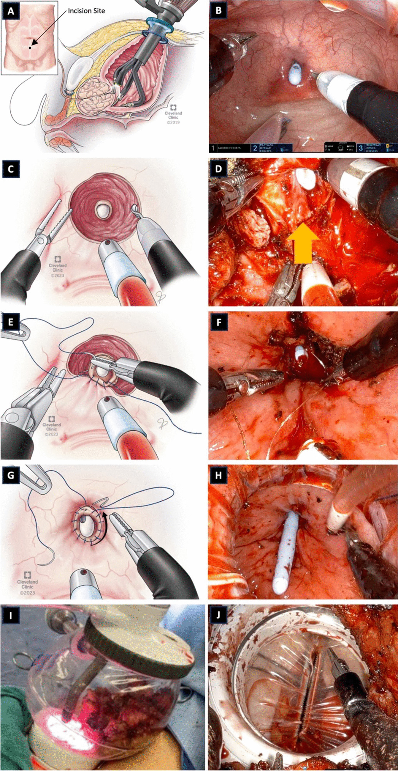 Single Port Robot-Assisted Simple Prostatectomy