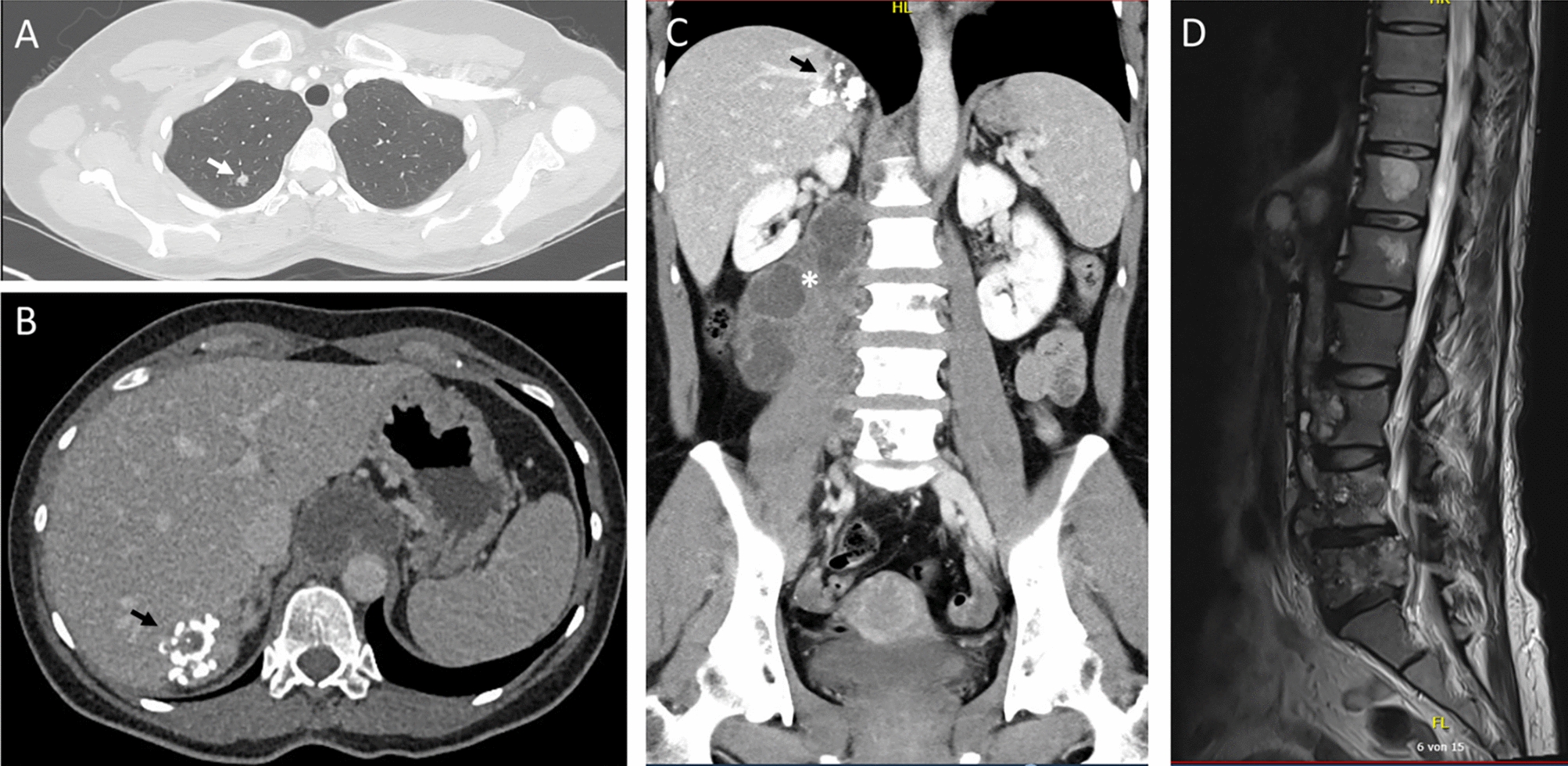 Unmasking the mimic: vertebral alveolar echinococcosis diagnosed by metagenomic next-generation sequencing