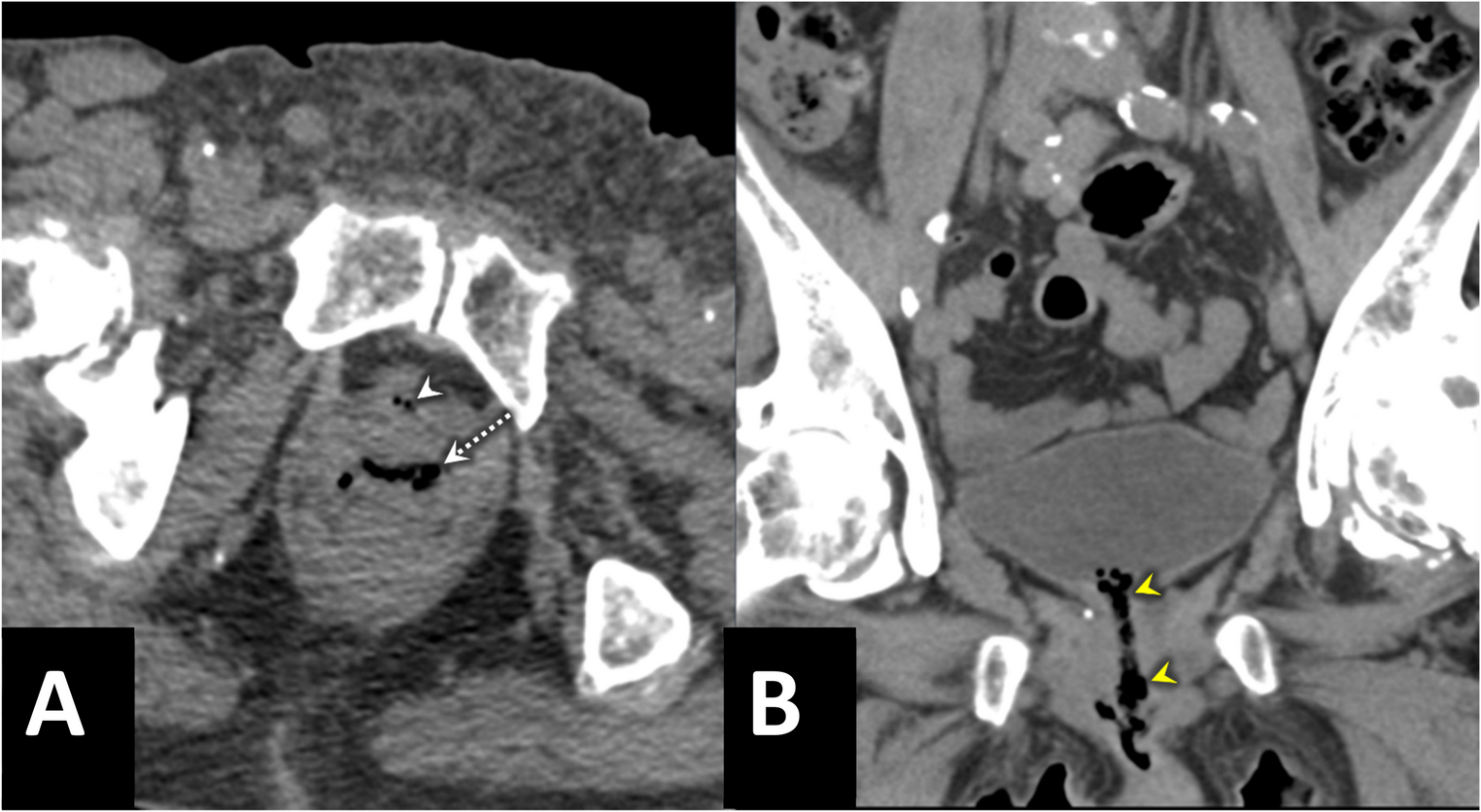 Computed tomography features of emphysematous vaginitis: anatomic distribution and pattern recognition
