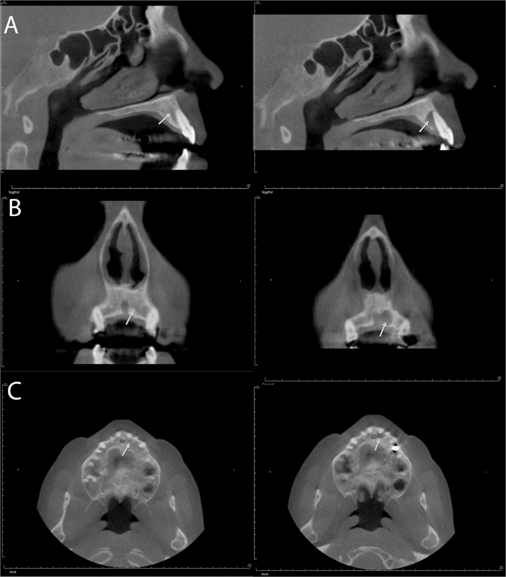Intraosseous hair-induced cyst-like lesion of the maxilla associated with trichotillomania: first reported case and review of the literature
