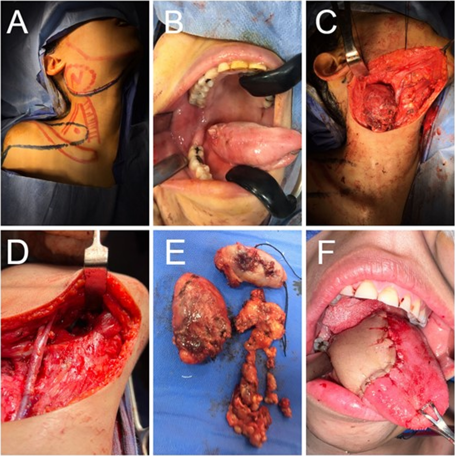 Tongue cancer in pregnancy: challenges and outcomes. A case series and review of the literature