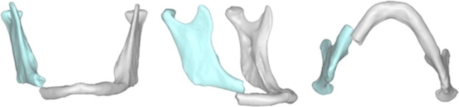 Virtual reduction and 3D printing in the management of edentulous atrophic mandibular body fractures: case series and literature review