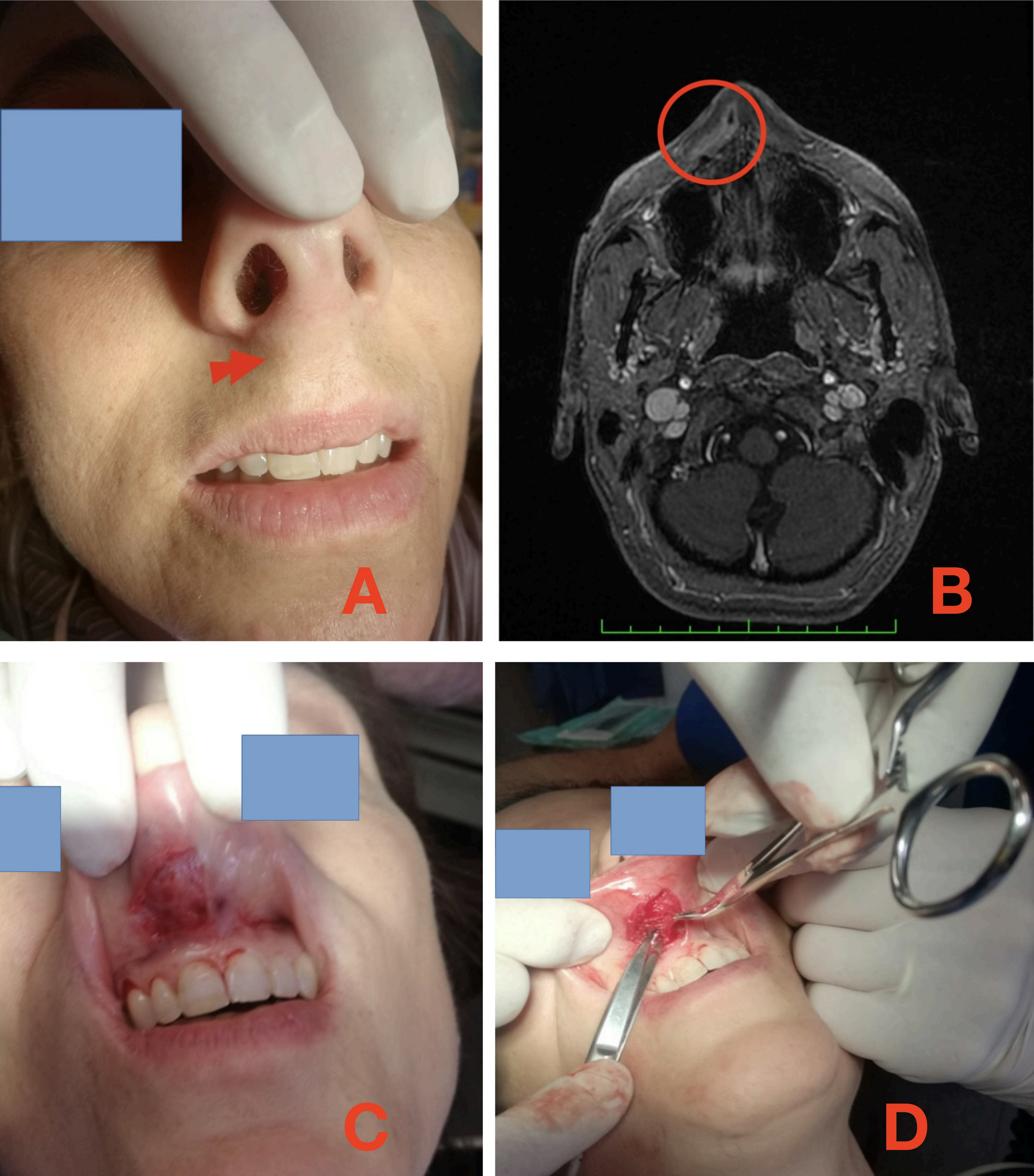 Nasolabial dirofilariasis in humans: a case report