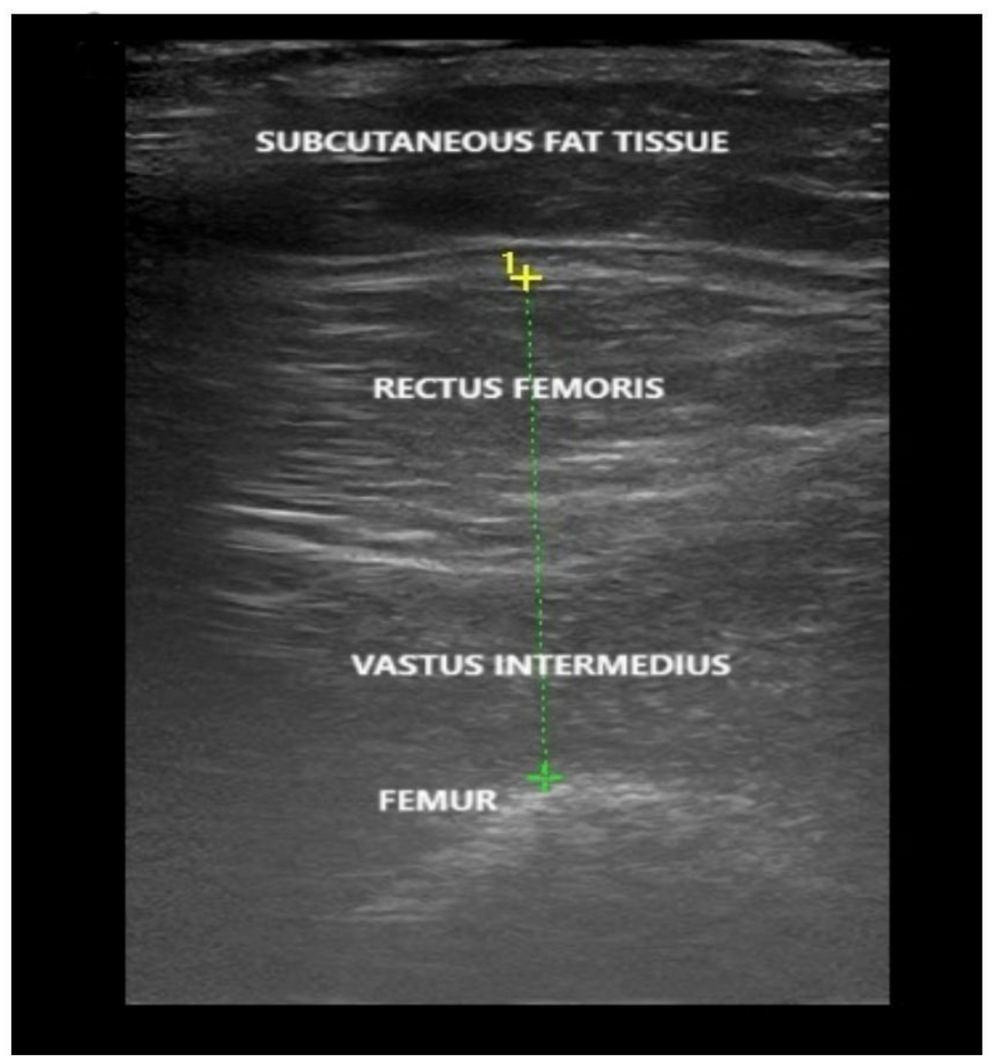 Swallowing Pathophysiology in Primary Sarcopenia: A Multimodal Assessment in Older Adults