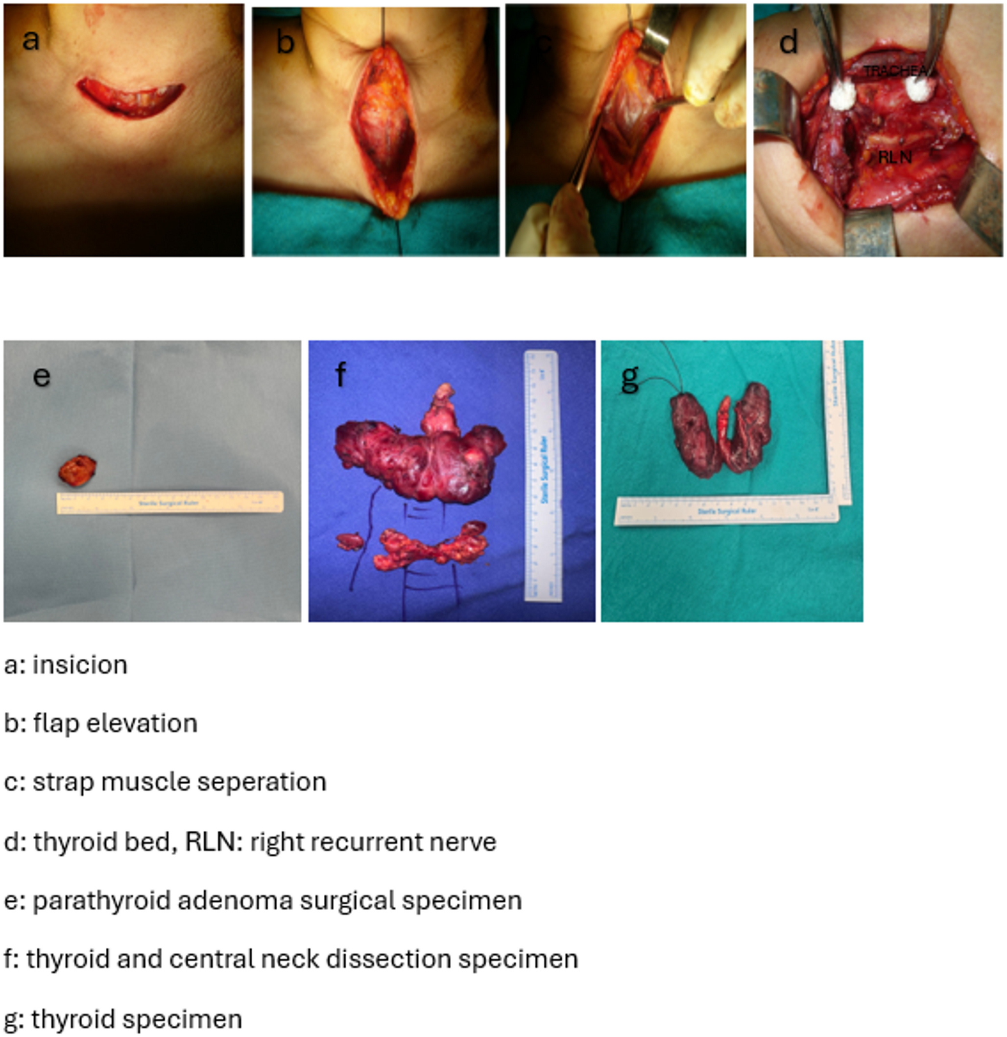 Swallowing Dysfunction Following Uncomplicated Thyroid and Parathyroid Surgery: A Prospective Evaluation of Early and Late Postoperative Changes