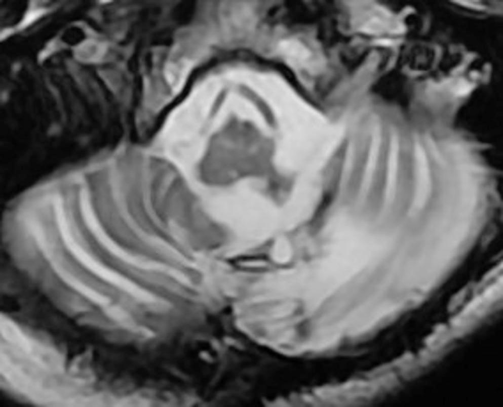 Rapid Bolus Inflow into the Esophagus in a Patient with a Tracheostomy after Surgical Treatment for Dysphagia