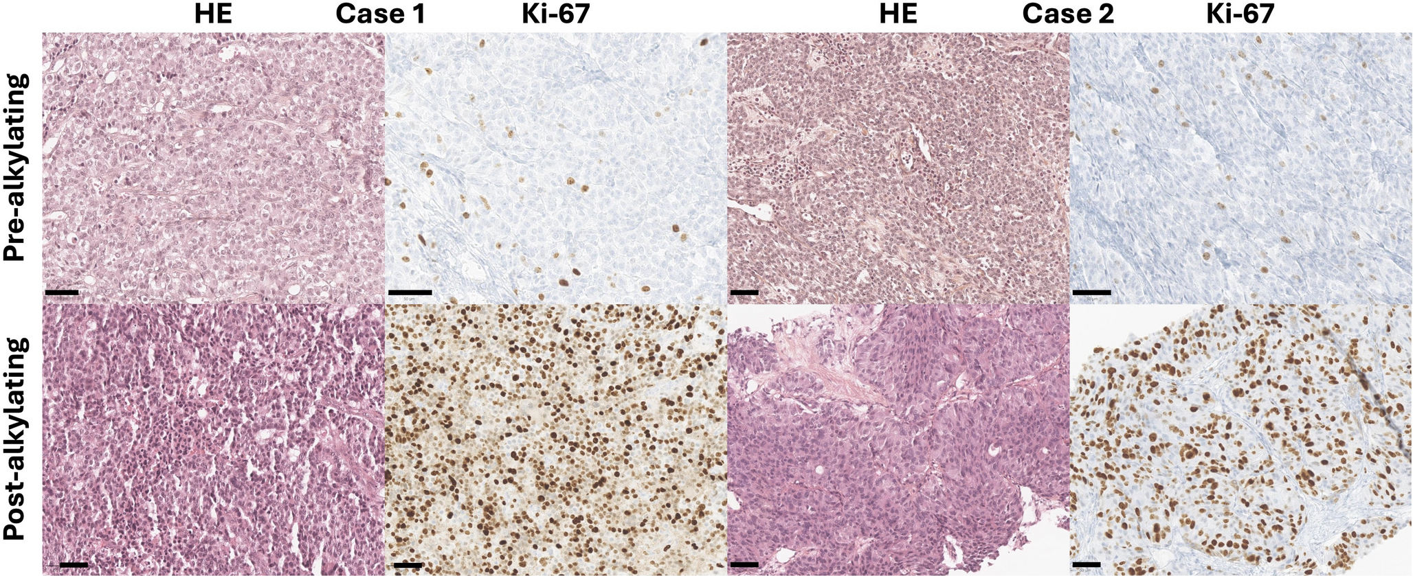 Immunotherapy for Metastatic Pancreatic Neuroendocrine Tumors with High Mutational Burden and Mismatch Repair Alterations Following Treatment with Alkylating Chemotherapy
