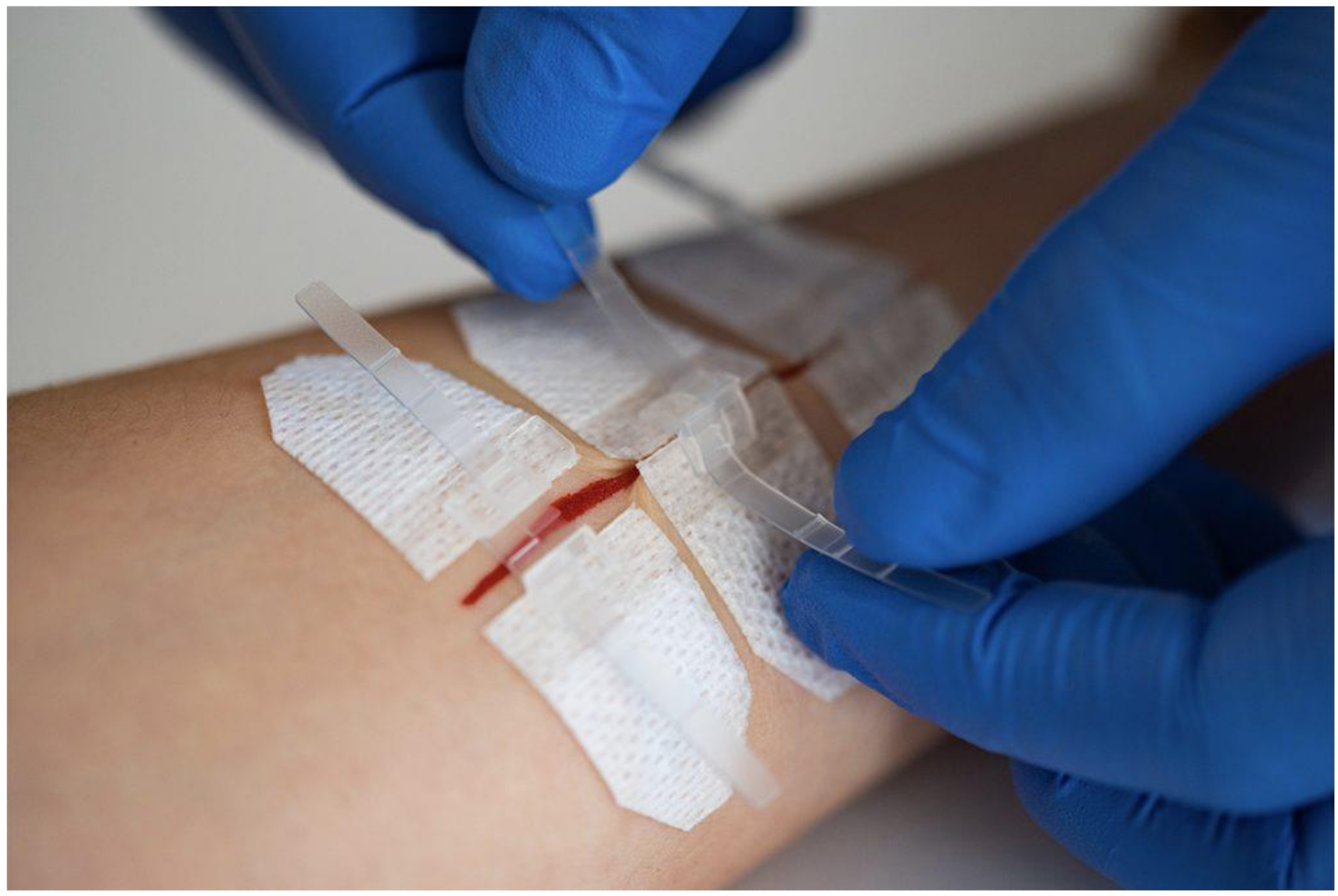Recent Technological Advances in Dermal Wound Closure in the Emergency Department