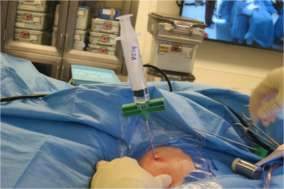 Outcomes of iliac crest bone marrow aspirate injection in the treatment of recalcitrant plantar fasciitis