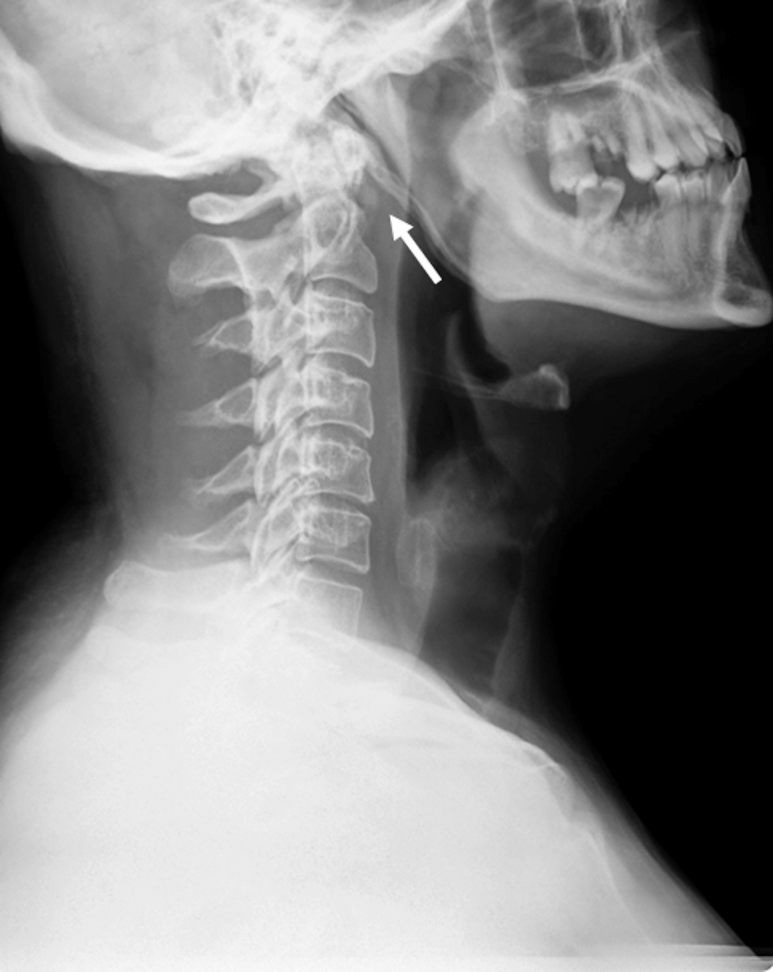 Longus colli calcific tendinitis, an uncommon cause of neck pain. A short series of cases and review of literature