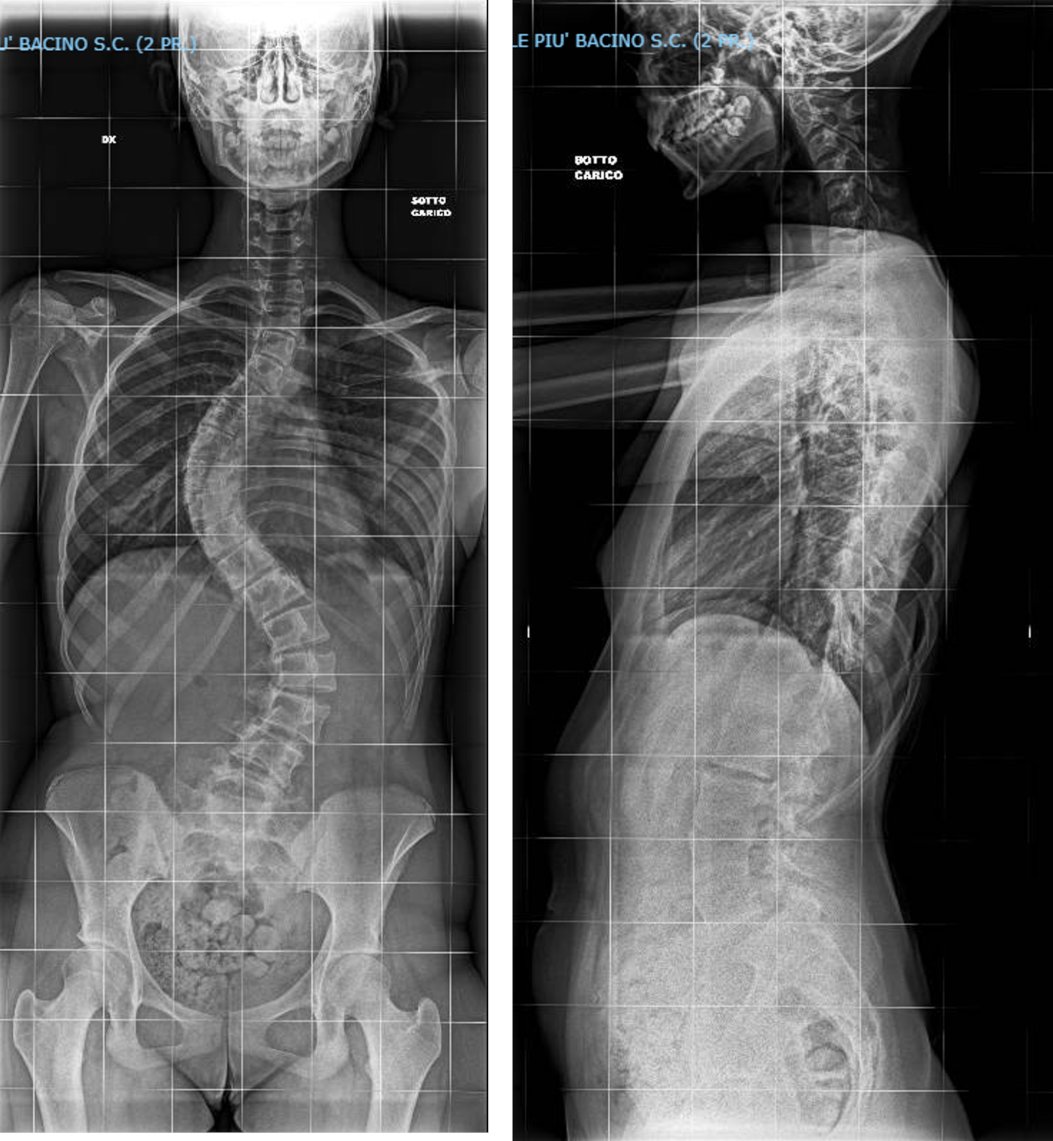 Simultaneous independent derotation as a valid and safe technique for adolescent idiopathic scoliosis Lenke type 3 and type 6 curves