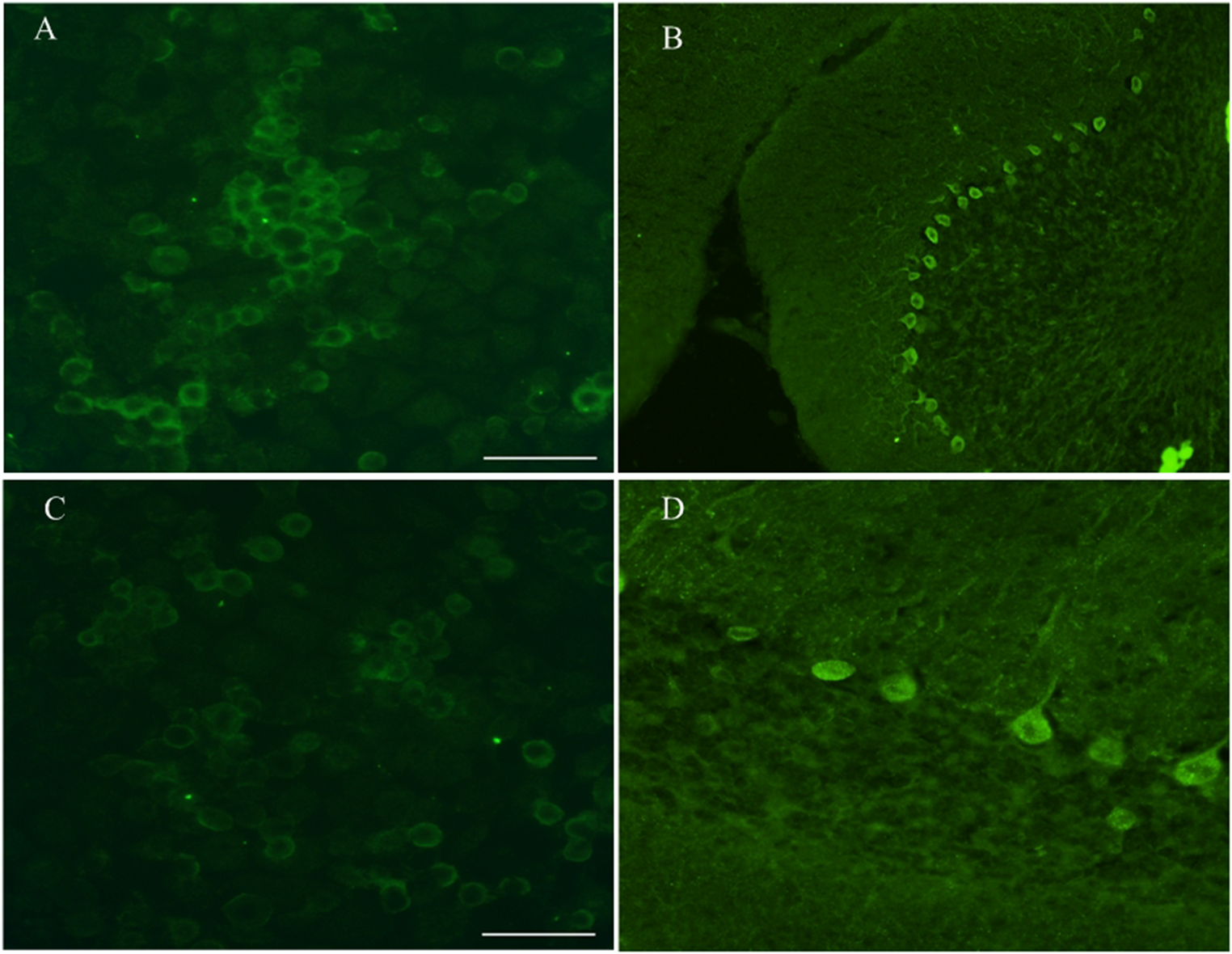 Anti-Tr/DNER Antibody-Associated Paraneoplastic Neurological Syndrome Complicated with Warthin Tumor: a Case Report and Literature Review