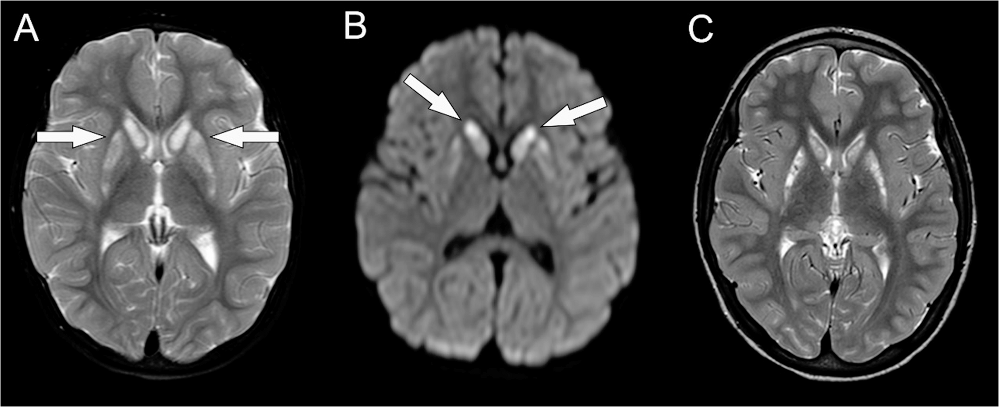 -Related Disorders: Description of New Variant and Phenotypic Spectrum Based on Age of Onset